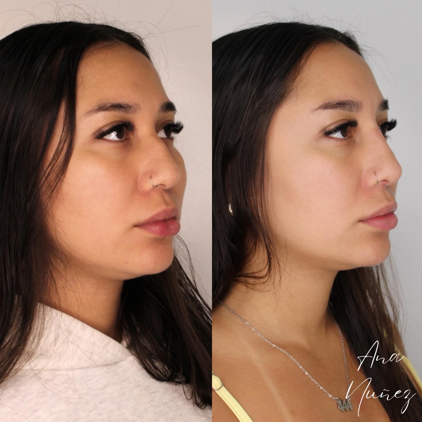 Resultado de harmonização orofacial — perfil