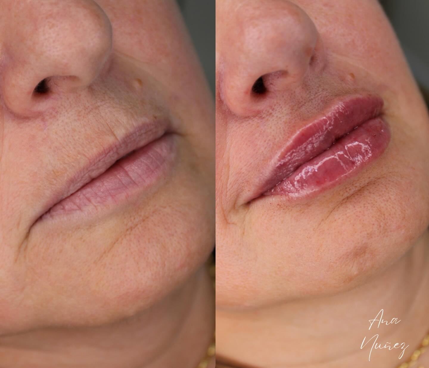 Resultado de preenchimento labial
