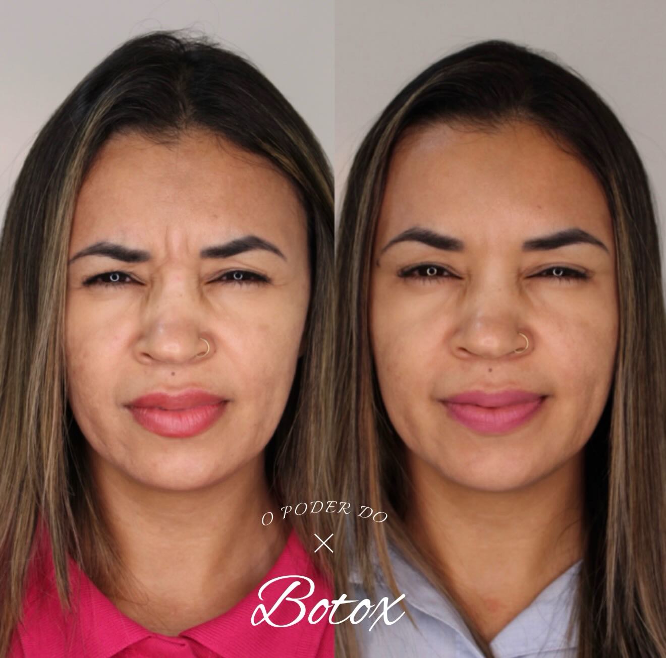 Resultado de aplicação de botox
