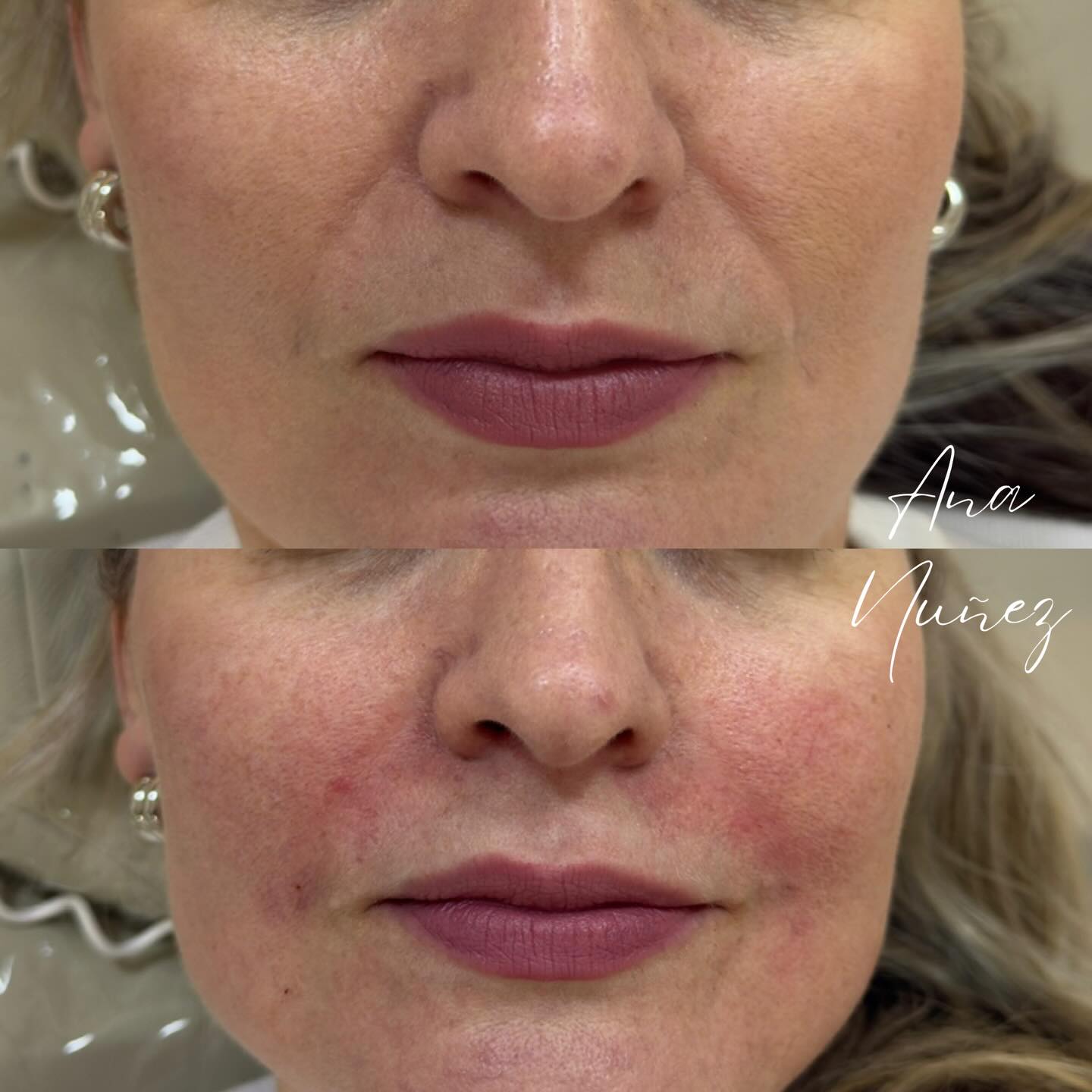 Resultado de preenchimento facial